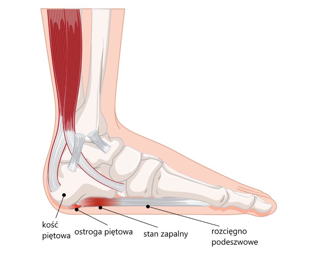 Zdjęcie przedstawia stopę z zapaleniem rozcięgna podeszwowego oraz ostrogę piętową. Widoczny jest na nim stan zapalny oraz narośl kostna, która jest główną przyczyną ostrogi piętowej.