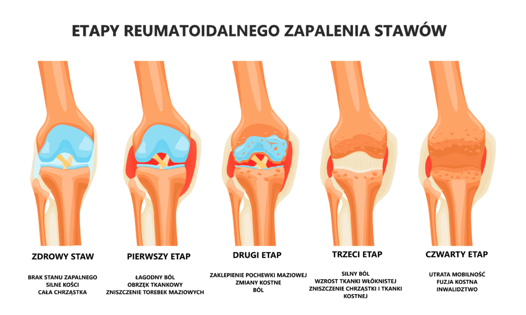 Rysunek przedstawia etapy RZS w przypadku stawu kolanowego