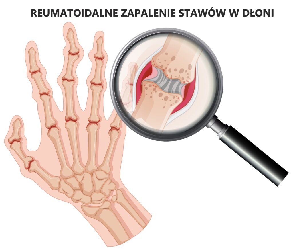 Obrazek przestawia dłoń i zwyrodnienia związane z RZS